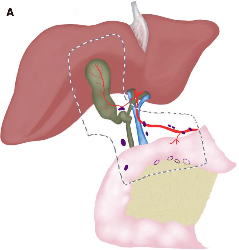 Dr. Rudresh Tabali, Senior Surgical Oncologist in Hubli, Successfully Treats Incidental Gallbladder Cancer in a 62-Year-Old Woman